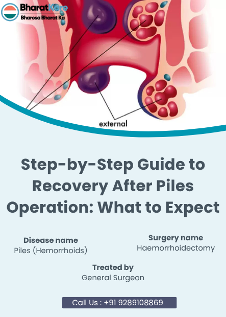Step-by-Step Guide to Recovery After Piles Operation