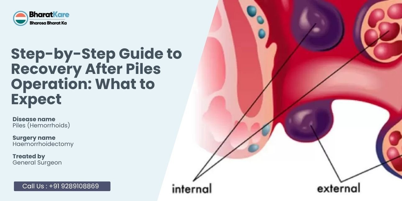 Step-by-Step Guide to Recovery After Piles Operation