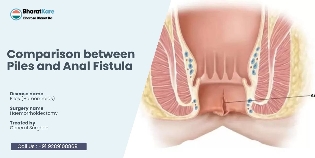 Comparison between Piles and Anal Fistula