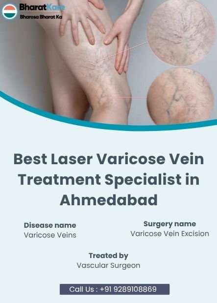 Best Laser Varicose Vein Treatment Specialist in Ahmedabad