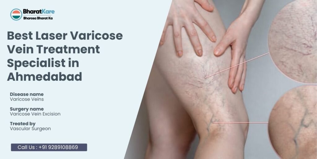 Best Laser Varicose Vein Treatment Specialist in Ahmedabad