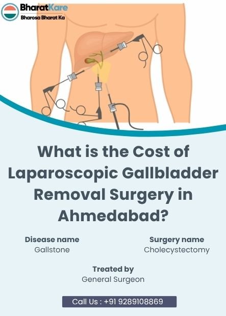 Laparoscopic Gallbladder Removal Surgery in Ahmedabad?