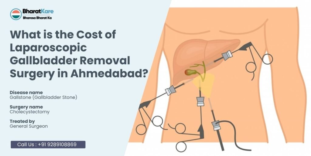 Laparoscopic Gallbladder Removal Surgery in Ahmedabad?