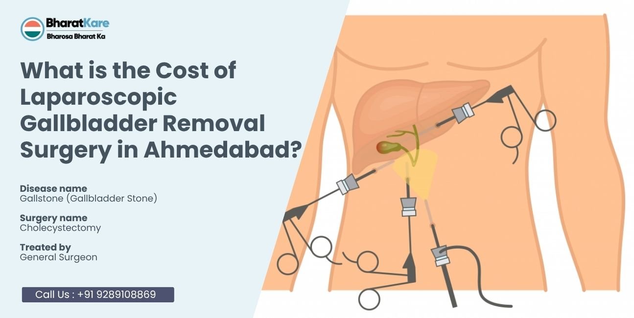 Laparoscopic Gallbladder Removal Surgery in Ahmedabad?