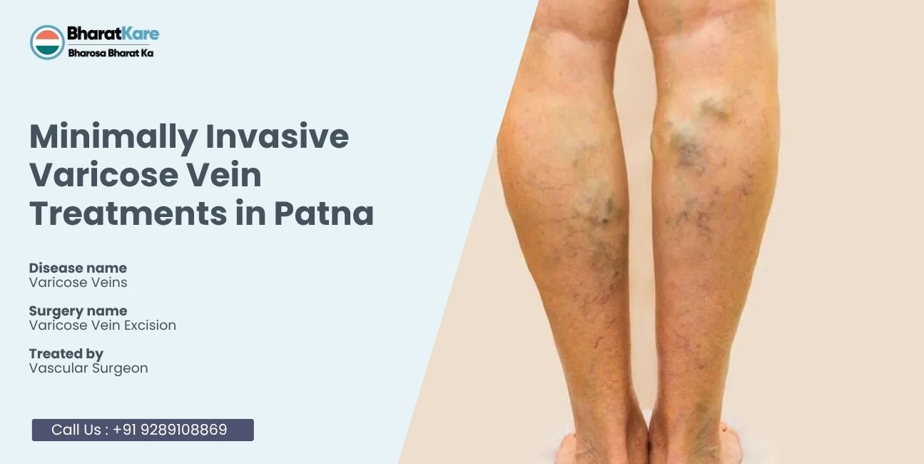 Varicose Vein Treatments in Patna