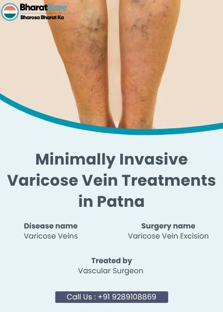 Varicose Vein Treatments in Patna