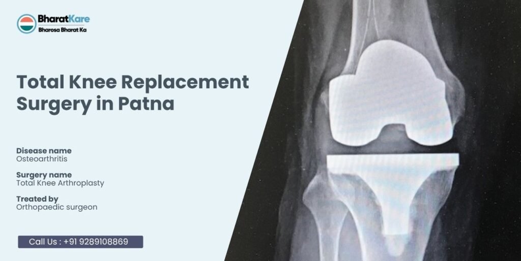 Knee Replacement Surgery in Patna