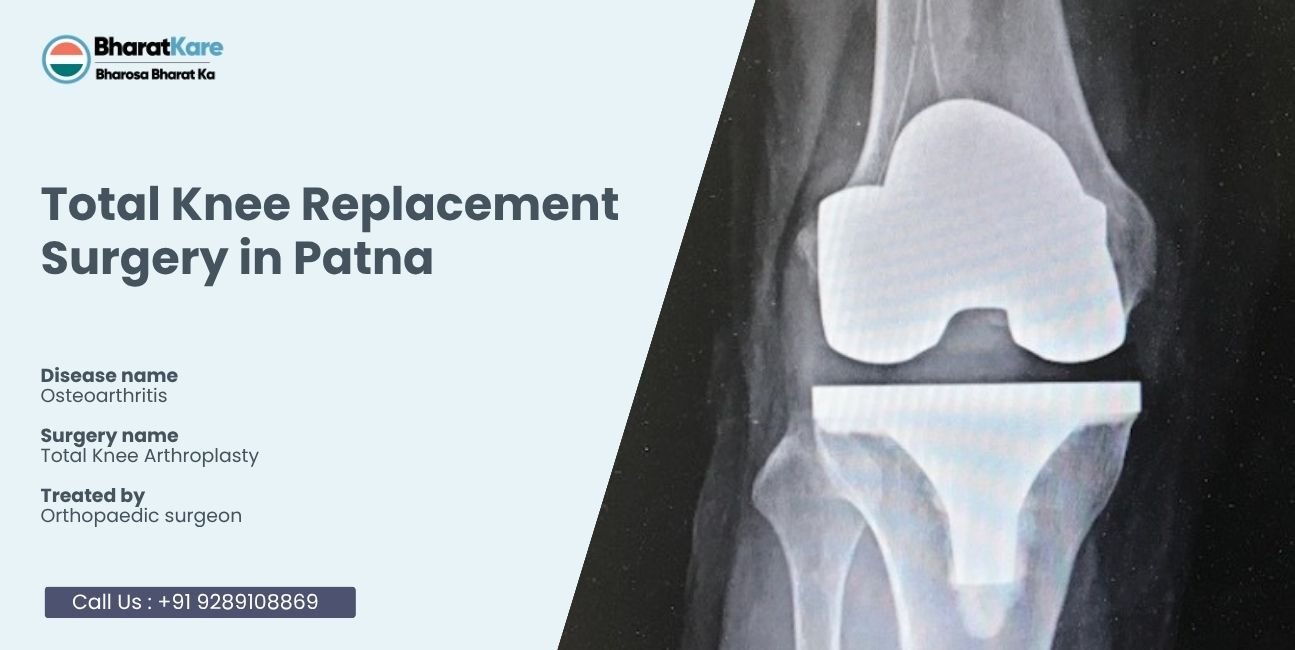 Knee Replacement Surgery in Patna