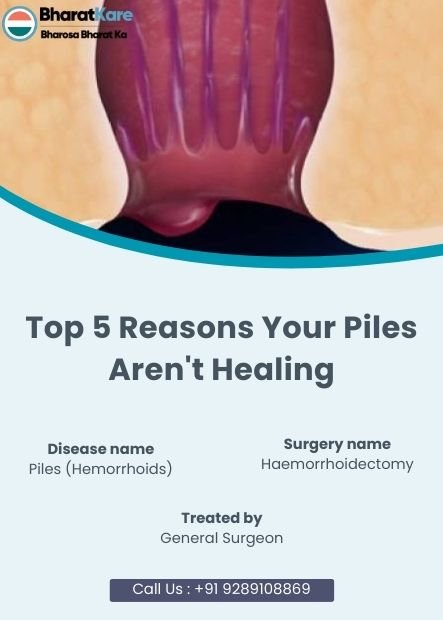 Top 5 Reasons Your Piles Aren't Healing