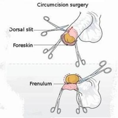 Laser Circumcision Treatment