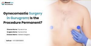 Gynecomastia Surgery in Gurugram: Is the Procedure Permanent?