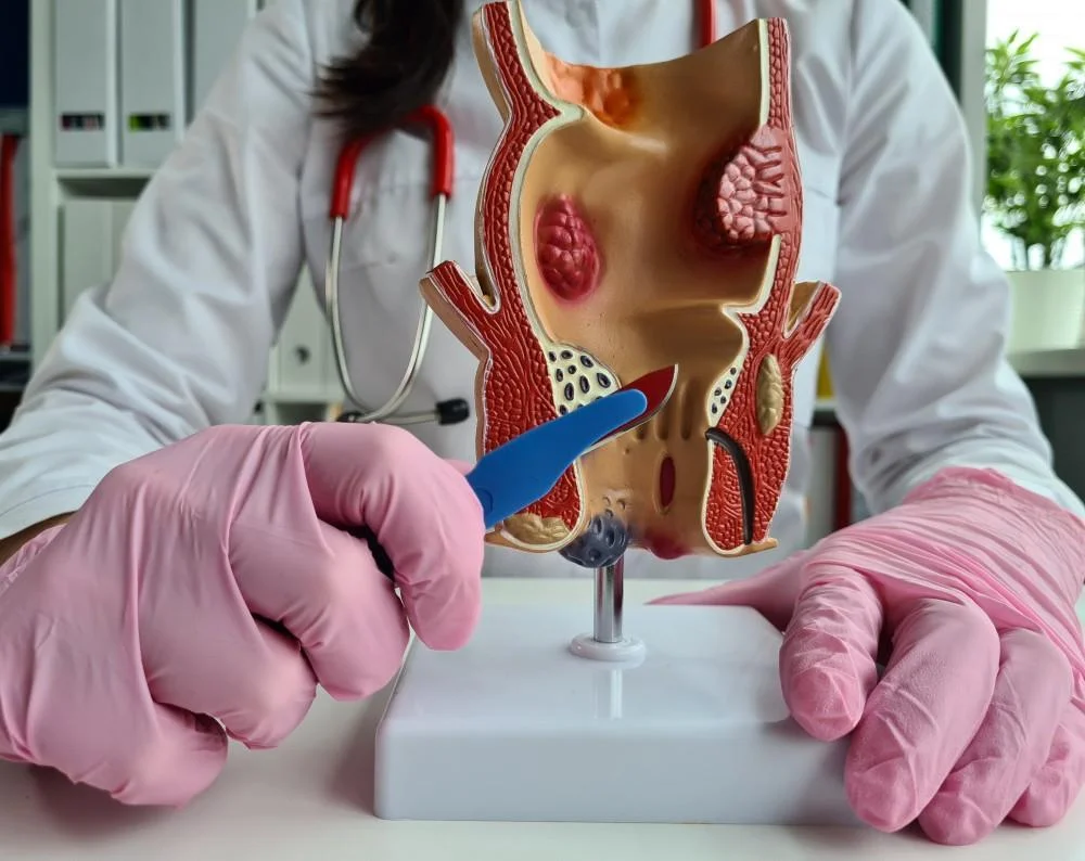 Anal fistula