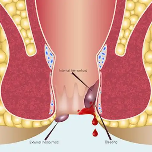 Anal Fissures