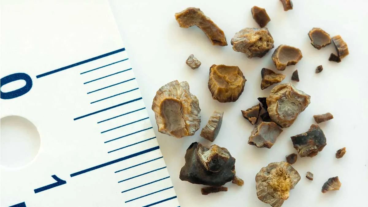 Gallstones Treatment