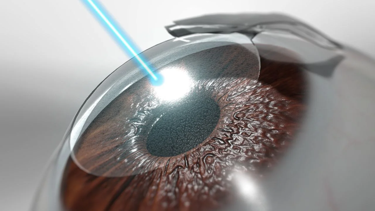 Lasik eye Surgery